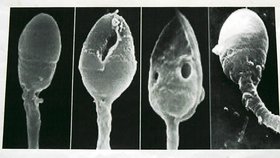 Takto vypadá defektní spermie. Bohužel takový snímek v mikroskopu vidí profesor Zdeněk Malý stále častěji