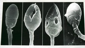 Takto vypadá defektní spermie. Bohužel takový snímek v mikroskopu vidí zdravotníci stále častěji