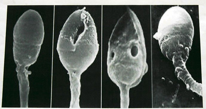 Takto vypadá defektní spermie. Bohužel takový snímek v mikroskopu vidí profesor Zdeněk Malý stále častěji.