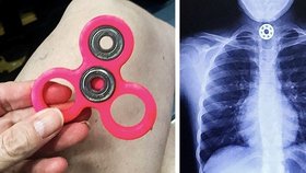 Dítě spolklo součást spinner fidgetu