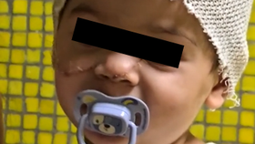 Dítě bodnuté strýcem do obličeje.