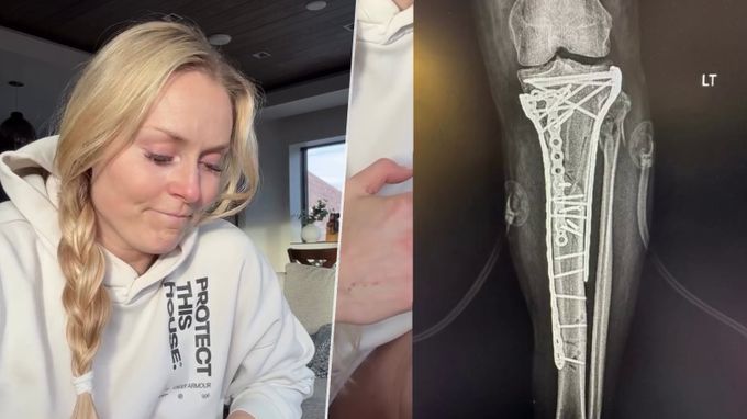 Zraněná Vonnová prozradila: Tohle mě zachránilo od amputace! Zraněná Vonnová prozradila: Tohle mě zachránilo od amputace!