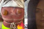 Šílené spáleniny z potápětí: Žena si z dovolenkového ráje přivezla obří puchýře