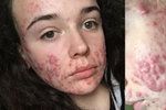 Teenagerka popsala život s brutálním akné: Agónie a posměšky