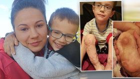Jakub (4) přišel o prsty na nohou i rukou: Maminka shání peníze na operaci, která mu má pomoci chodit