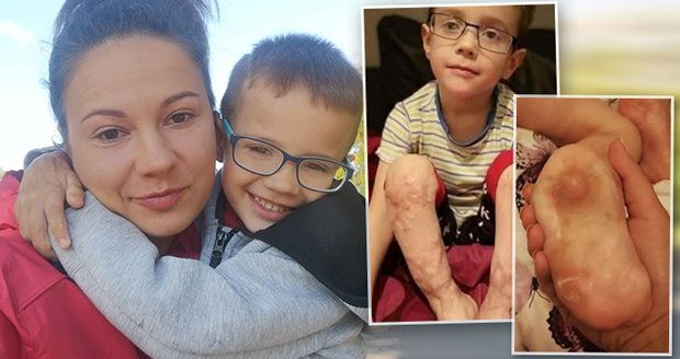 Jakub (4) přišel o prsty na nohou i rukou: Maminka shání peníze na operaci, která mu má pomoci chodit