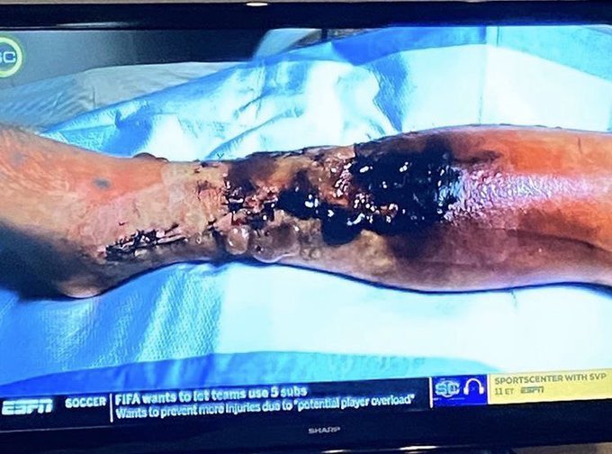 Takhle vypadala Smithova noha pár dní po ošklivém zranění z listopadu 2018