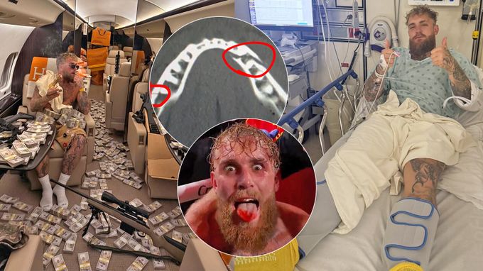 Dozvuky Paulova knockoutu: zlomená čelist a tekutá strava. Pochlubil se miliony v letadle Dozvuky Paulova knockoutu: zlomená čelist a tekutá strava. Pochlubil se miliony v letadle