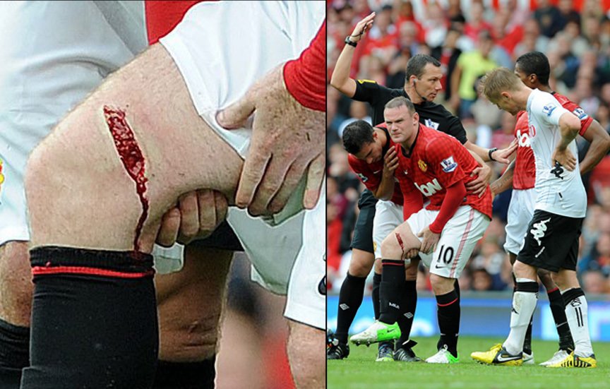 Wayne Rooney skončil s krvavým šrámem a čtyři týdny si nezahraje