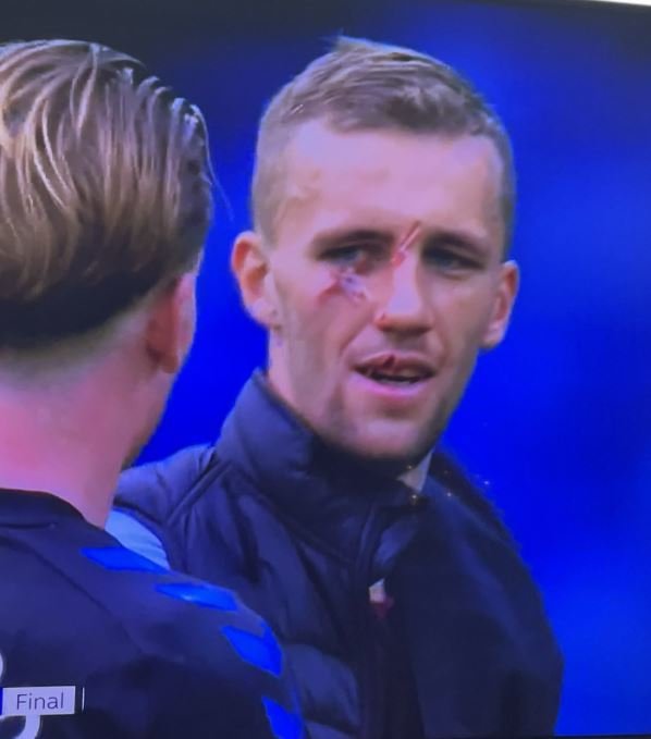 Tomáš Souček po utkání s Evertonem, kdy byl zasažen kopačkou do tváře