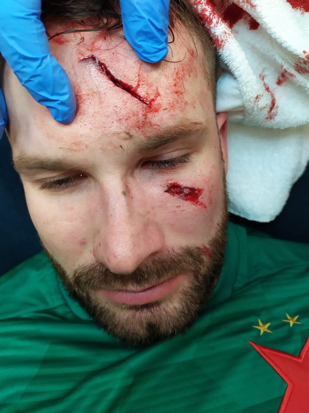 Zakrvácená tvář Ondřeje Koláře, který schytal děsivou kopačku do obličeje