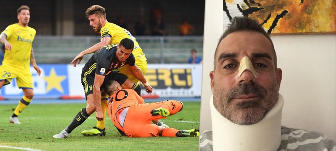 Stefano Sorrentino odešel z kolize s Cristianem Ronaldem mimo jiné se zlomeným nosem