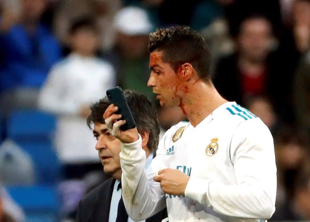 2018. Jedna bizarní záležitost. Ronaldo přímo v průběhu zápasu na mobilu lékaře kontroloval, jak vypadá po krvavém souboji.