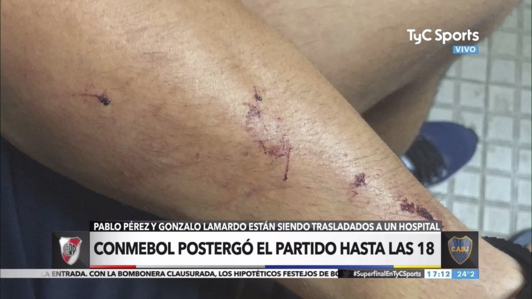 Pořezaná ruka Pabla Péreze po napadení autobusu