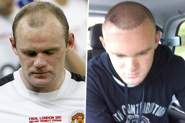 Wayne Rooney po transplantaci vlasů