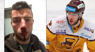 Další útok na hokejistu z Jihlavy! Hlinku zmlátili, má otřes mozku