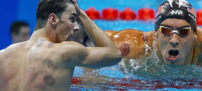 Hvězdný plavec Michael Phelps má na svém těle viditelné podlitiny, jsou způsobeny regenerační metodou, tzv. baňkováním