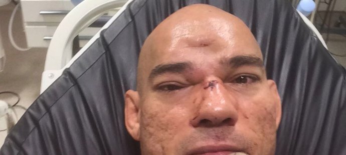 Proražená lebka zápasníka MMA Evangelisty Santose