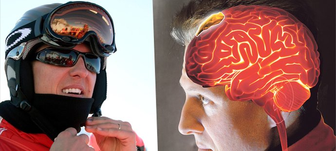 Michaelu Schumacherovi praskla při nehodě na lyžích helma, pod lebkou má několik subdurálních hematomů