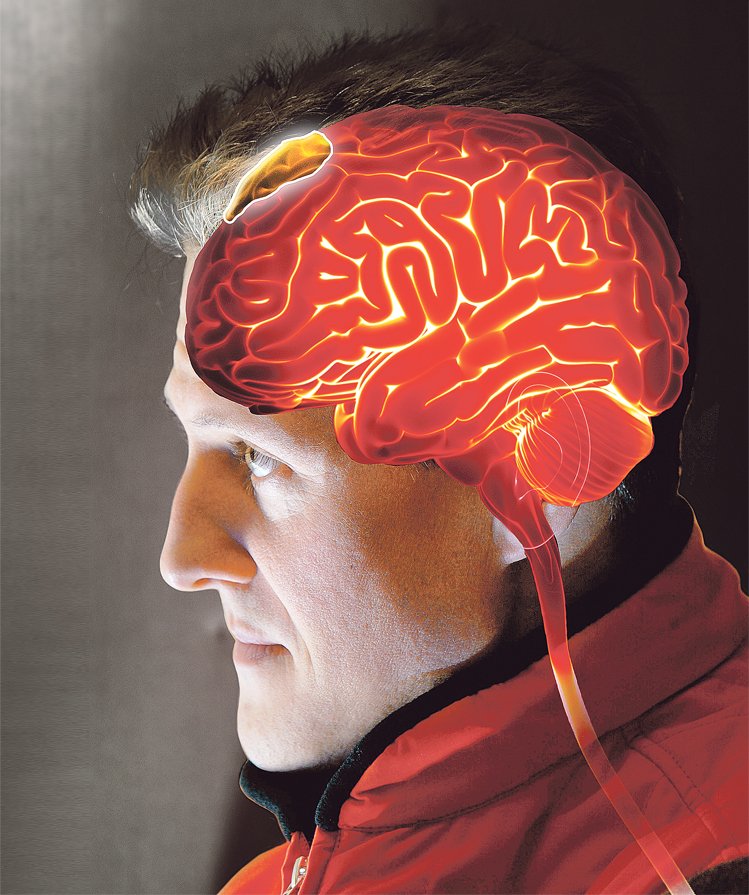 Michael Schumacher má několik otoků na mozku, jeden se v úterý podařilo lékařům odstranit. Co je subdurální hematom? Druh traumatického poranění mozku, při kterém se přetrhají žilky v ochranné membráně mozku a  dojde k otoku. Krev se hromadí mezi tvrdou plenou mozkovou a povrchem mozku a způsobuje tlak na mozkovou tkáň. Mezi symptomy patří bolest hlavy, zvracení, poruchy vědomí a někdy i zhoršení intelektu.
