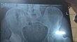 Rentgenový snímek po operaci kyčelního kloubu Andyho Murrayho
