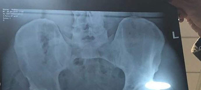 Rentgenový snímek po operaci kyčelního kloubu Andyho Murrayho