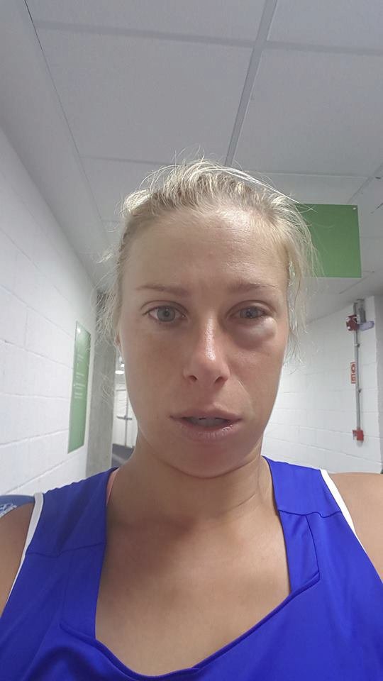 Andrea Hlaváčková s nateklým okem po utkání ve čtyřhře poté, co dostala míčem od Martiny Hingisové