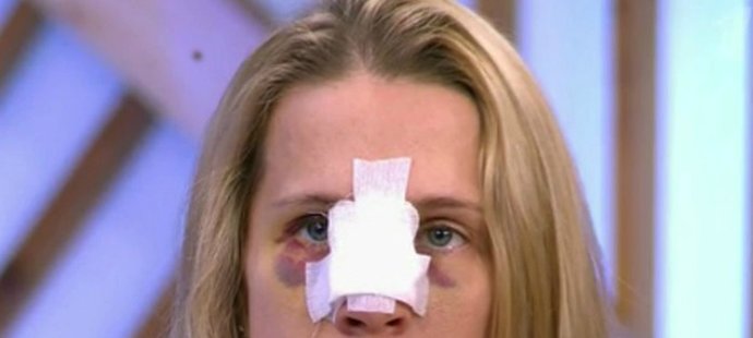 Cyklistka Naděžda Semeňuková poté, co jí bývalý manžel Roman Paramonov zlomil nos.