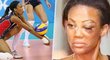 Někdejší volejbalistka Prostějova a olympijská medailistka Kim Glassová byla napadena bezdomovcem. Po útoku měla poraněné oko