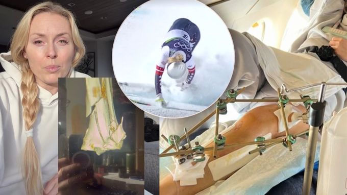 Pět operací, které jí zachránily nohu! Vonnová přiznala: Strašná bolest. A co bude dál? Pět operací, které jí zachránily nohu! Vonnová přiznala: Strašná bolest. A co bude dál?