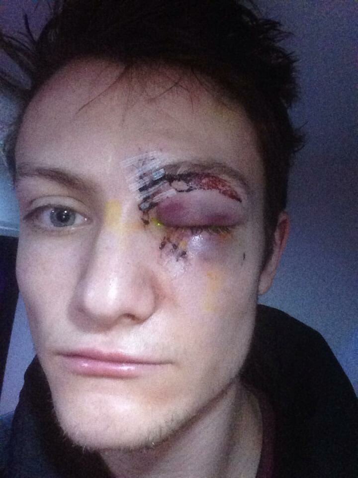 Zranění oka ke kterému přišel během utkání