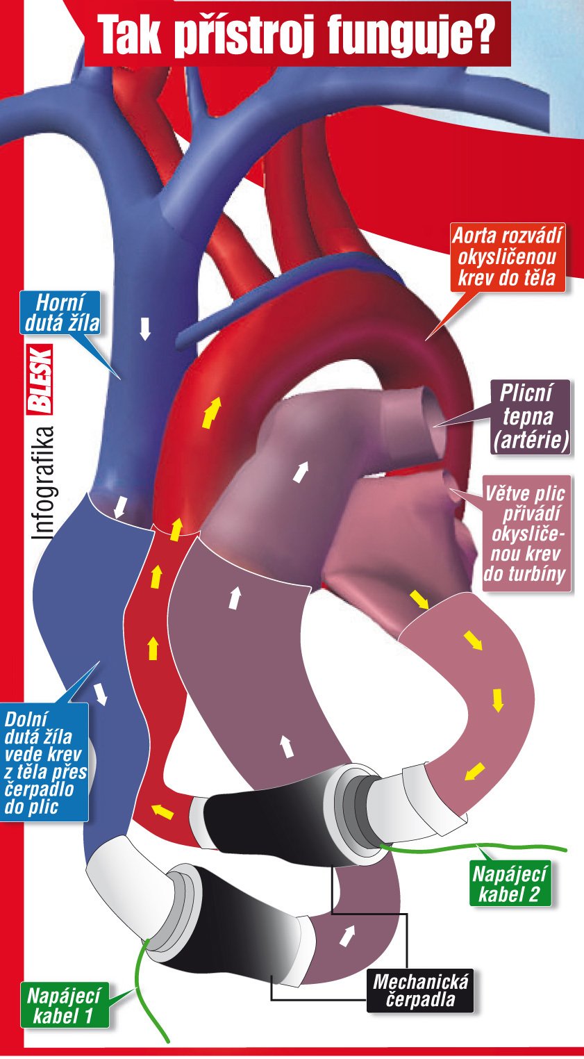 Takto přístřoj, který nahradil Jakubovo srdce, pracoval