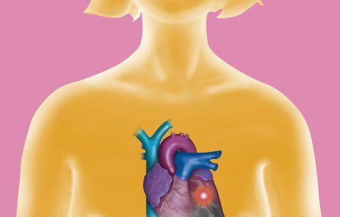 Mýty a pravdy o srdeční arytmii: Může to potkat i vás!