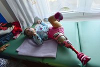 Pavlínka v 7 měsících onemocněla meningokokem: Amputovali jí nožičku, byla v umělém článku