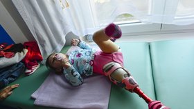 Pavlínka v 7 měsících onemocněla meningokokem: Amputovali jí nožičku, byla v umělém článku