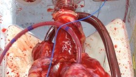 Srdce je čtyři hodiny před transplantací naloženo ve speciálním roztoku.