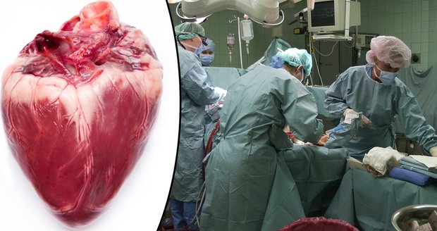 Muži transplantovali umělé srdce. Po 75 dnech zemřel.