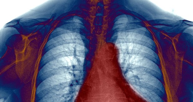 Při plicní hypertenzi dochází ke zvýšené námaze pravé komory srdeční, která se postupně zvětšuje.