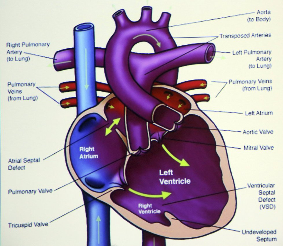 V Česku se se srdeční vadou narodí jedno dítě ze sta.