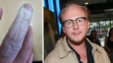 Štěpán Kozub má ošklivou popáleninu: Záchod, to je velký problém...