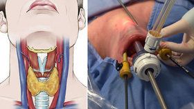 Poprvé v Česku: Lékaři z Brna operovali ženě štítnou žlázu ústy! Nebude mít jizvu