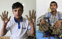 16 operací »stromového muže«: Ořezali z něj 5 kg bradavic!
