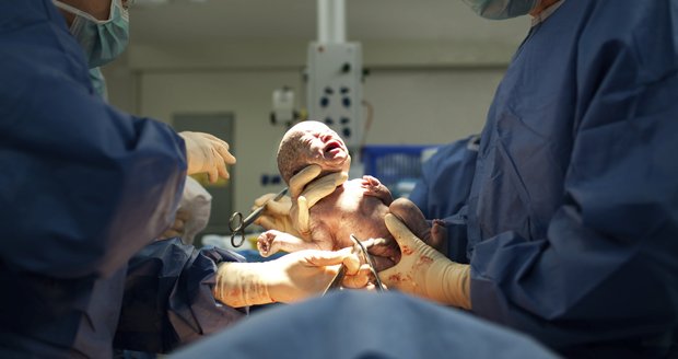 Raději císařský řez než porodní bolesti? Ohrožujete tím děti, varují lékaři rodičky