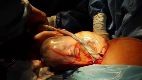 Dítě se rozhlédlo přes plodové obaly během porodu