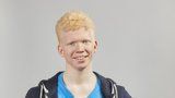 Téměř slepý albín ze SuperStar: Diváci se mu chtějí složit na speciální brýle