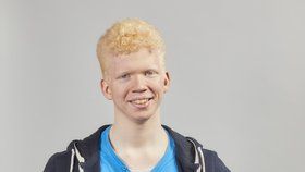 Téměř slepý albín ze SuperStar: Diváci se mu chtějí složit na speciální brýle