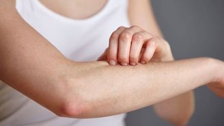 Nesnesitelné svědění a vyrážka. Svrabu se daří celoročně a jeho výskyt neklesá Nesnesitelné svědění a vyrážka. Svrabu se daří celoročně a jeho výskyt neklesá