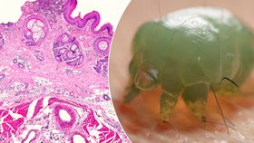 Svrab způsobuje zákožka svrabová