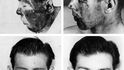 Ukázka, jak pracoval MUDr. Archibald McIndoe – rekonstrukce popáleného obličeje F/O Vernona E. Mitchella.