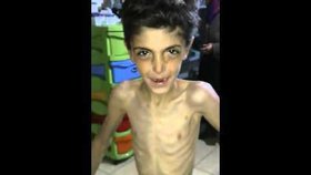 Děsivé snímky pohublých dětí ze syrského města